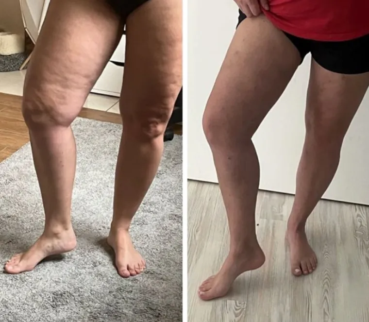 Antes e depois real das pernas