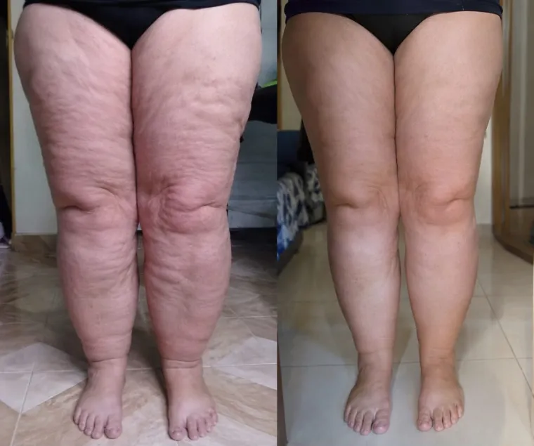 Antes e depois real das pernas